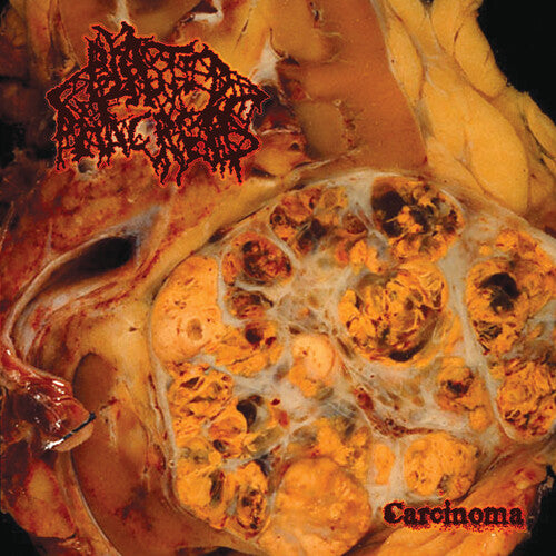 Image of the Music Record - Carcinoma by Blasted Pancreas